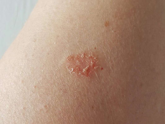 Using Tallow for Eczema