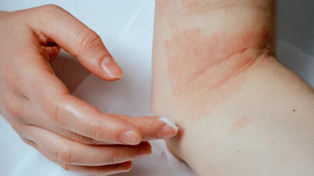 Tallow Balm for Eczema