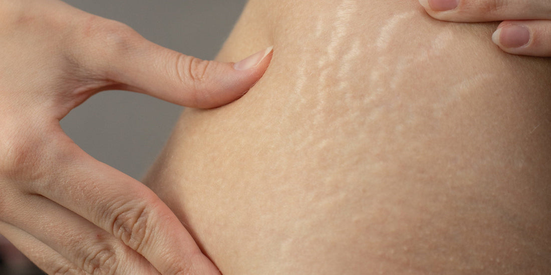 Beef Tallow for Stretch Marks